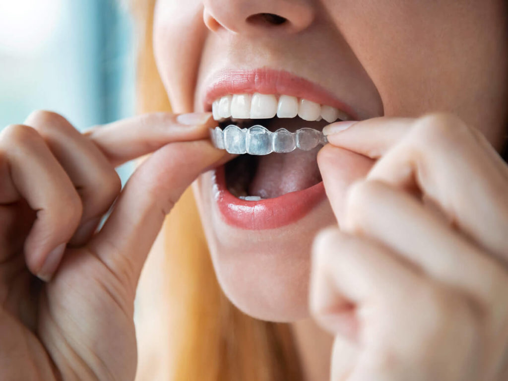 women inserting invisalign clear aligner to top row teeth