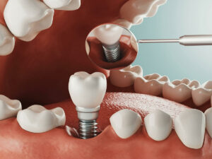 illustration of a dental implant being inserted into the bottom row of teeth